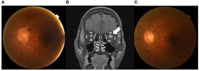 Case report: Sudden onset optic neuritis shortly after SARS-CoV-2 vaccination in an allogeneic hematopoietic stem cell transplant recipient with chronic graft-vs.-host disease